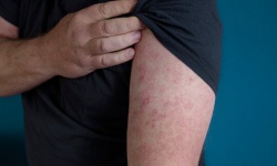 Delayed-type hypersensitivity (DTH)